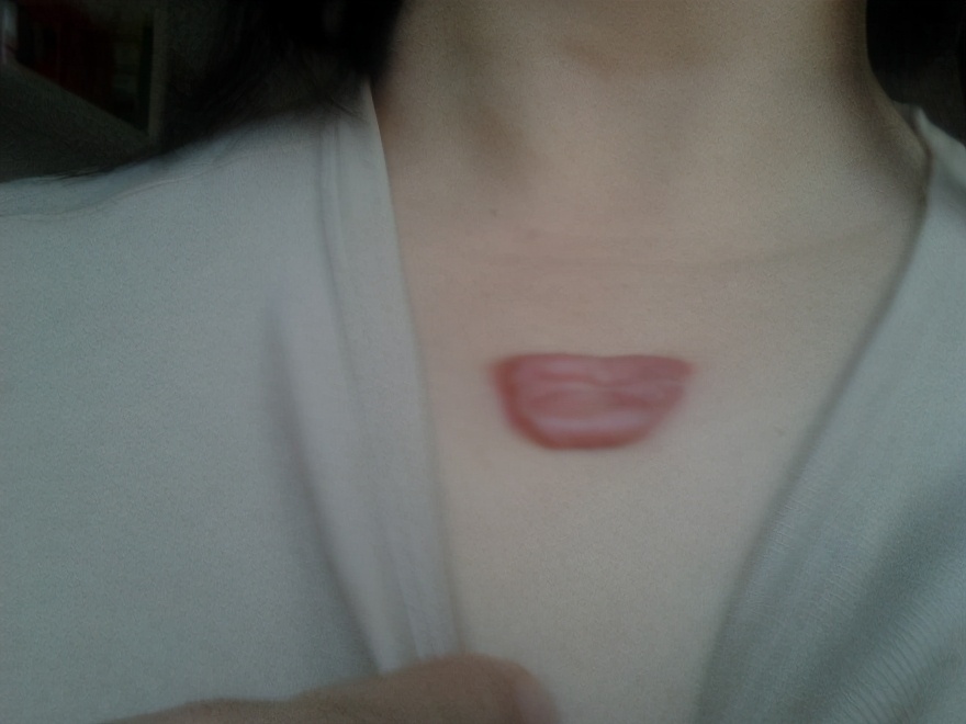 胸前疤痕疙瘩祛疤手术一般多少钱,胸前有一个蝴蝶状疤痕疙瘩怎么治