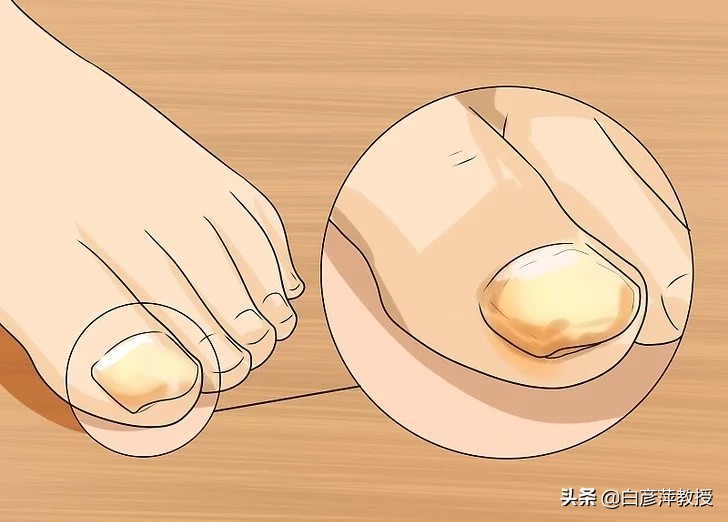 灰指甲是灰色的吗？灰指甲真的会传染吗？皮肤科医生告诉你