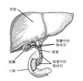 89岁老人腹部疼痛？已致危重！胃病？不，这是胆囊炎