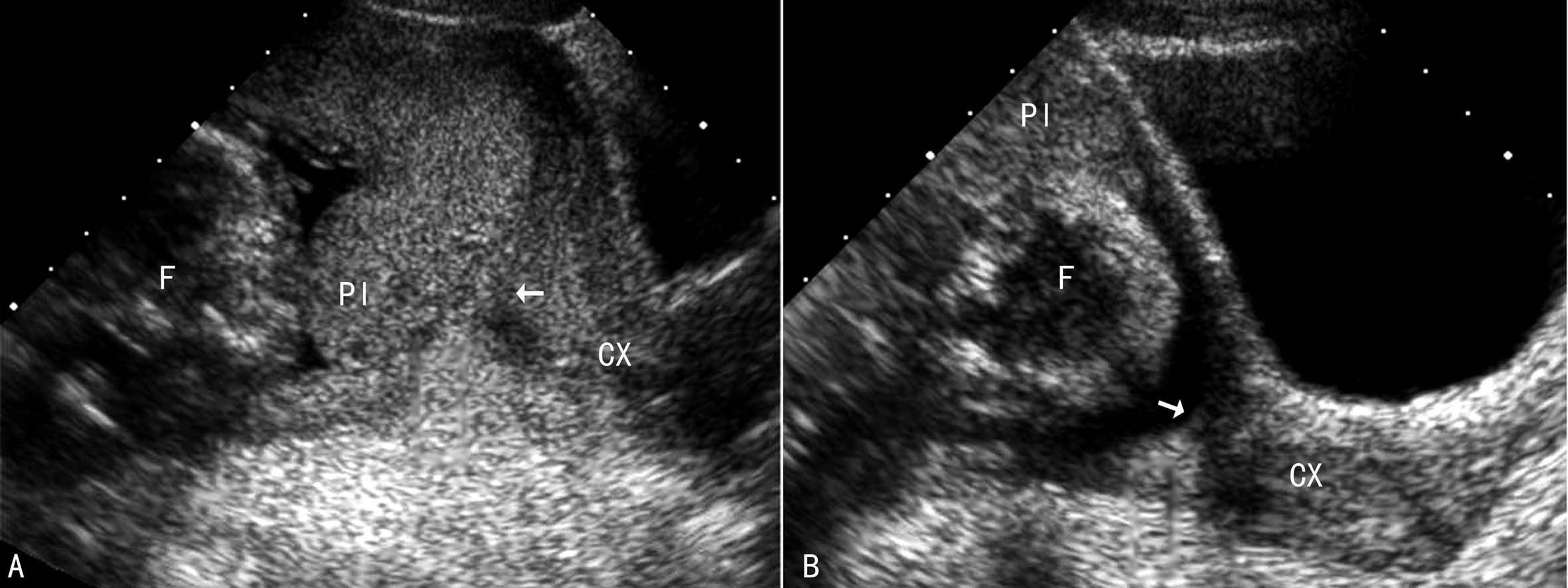 超声如何诊断前置胎盘,前置胎盘核磁报告显示胎盘无异常