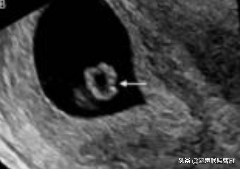 3毫米卵黄囊未见胎芽正常么,40多天的卵黄囊