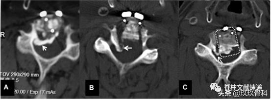 acaf手术适应脊髓型颈椎病吗,acaf术后康复方法