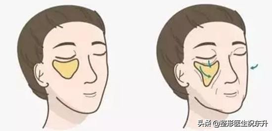 做了很多次医美法令纹还去不掉,法令纹的印子是不是去不掉了