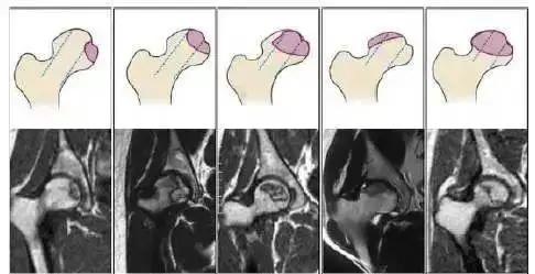 股骨头坏死修复阶段x线表现,股骨头坏死打孔减压术后恢复多久