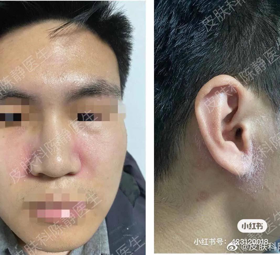 鼻头发红是日光性皮炎还是酒渣鼻,鼻头隐约有点红