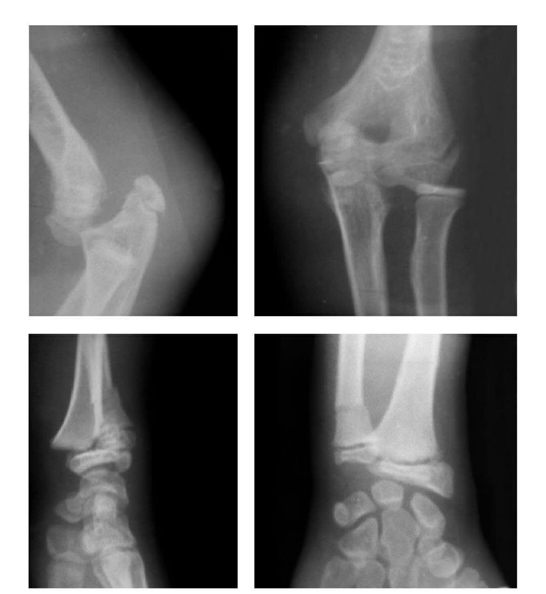 青少年肘部损伤最常见的是,肘部桡神经损伤的临床表现