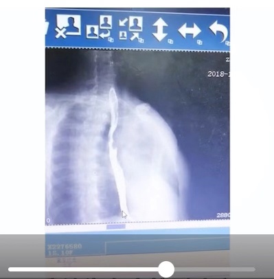 慢性咽炎吃什么药对胃没影响,慢性咽炎是否伴有恶心与胃不舒服