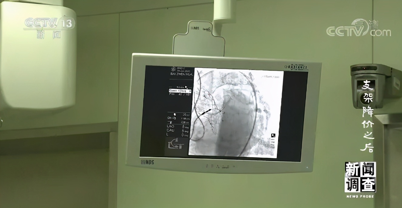 支架降价没,支架降价后有些医生开始滥用球囊