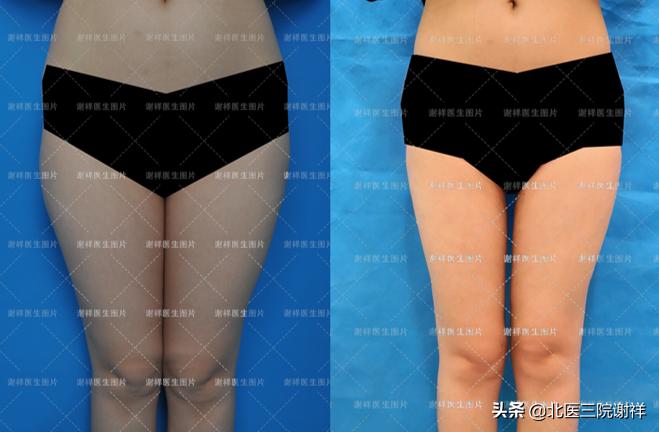 腿部吸脂对运动有影响吗,腿部吸脂真的可以直腿吗