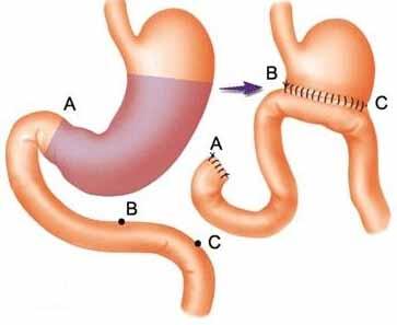 顽固胃动力障碍,胃癌手术后胃动力不足能恢复吗