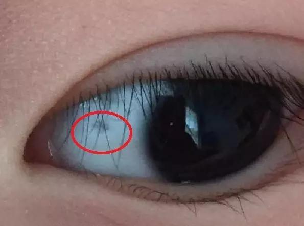 孩子眼白有小黑点是什么原因,儿童眼白有黑点是什么原因