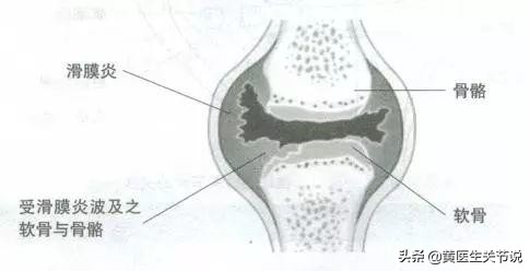 导致膝关节疼痛的原因有很多，防治方法有哪些？