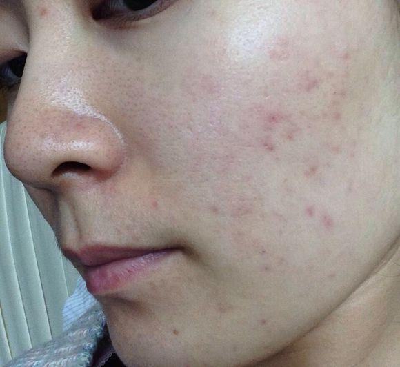 收缩毛孔最有效的方法真的有吗,收缩毛孔最省钱的方法