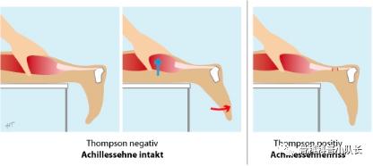 崴脚超过24小时是热敷还是冷敷,崴脚超过48小时是热敷还是冷敷