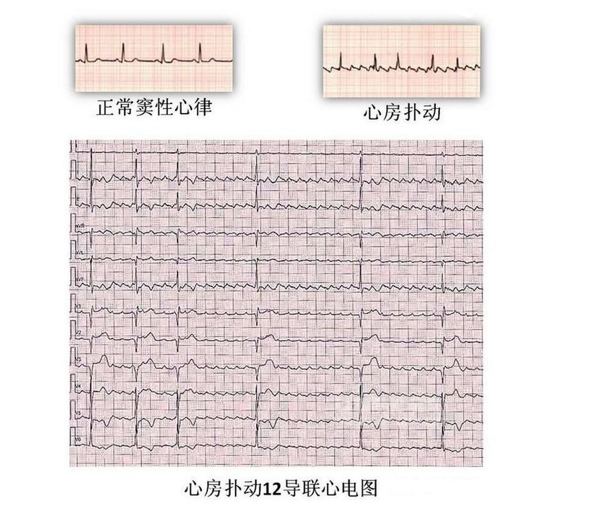 房颤与心律失常怎么解决,心律失常房颤的症状及危害