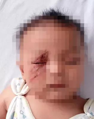 小女孩被蜱虫咬了险丧命,孩子被毒虫咬了怎么办