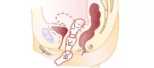 子宫脱垂切掉子宫,子宫脱垂切子宫就能改善吗