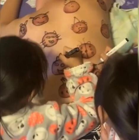 爸爸拔罐留下的印子,爸爸拔火罐后续