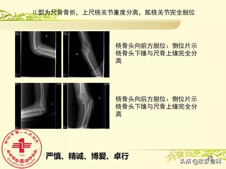 孟氏骨折功能训练多久能恢复正常,孟氏骨折中医能治吗
