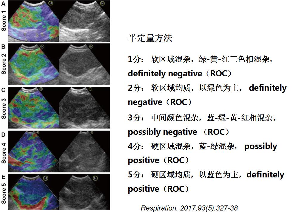孙加源门诊,治疗肺癌的新技术新手段