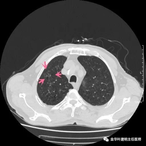 多发原发肺癌能根治吗,肺部原发性恶性肿瘤好治