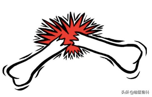 不小心摔伤骨折了怎么办,户外骨折怎么办