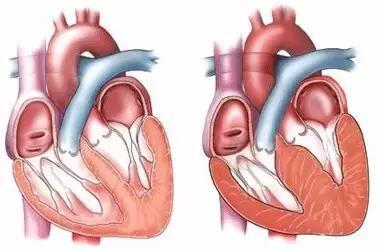 高血压，心脏肥厚了怎样选药？