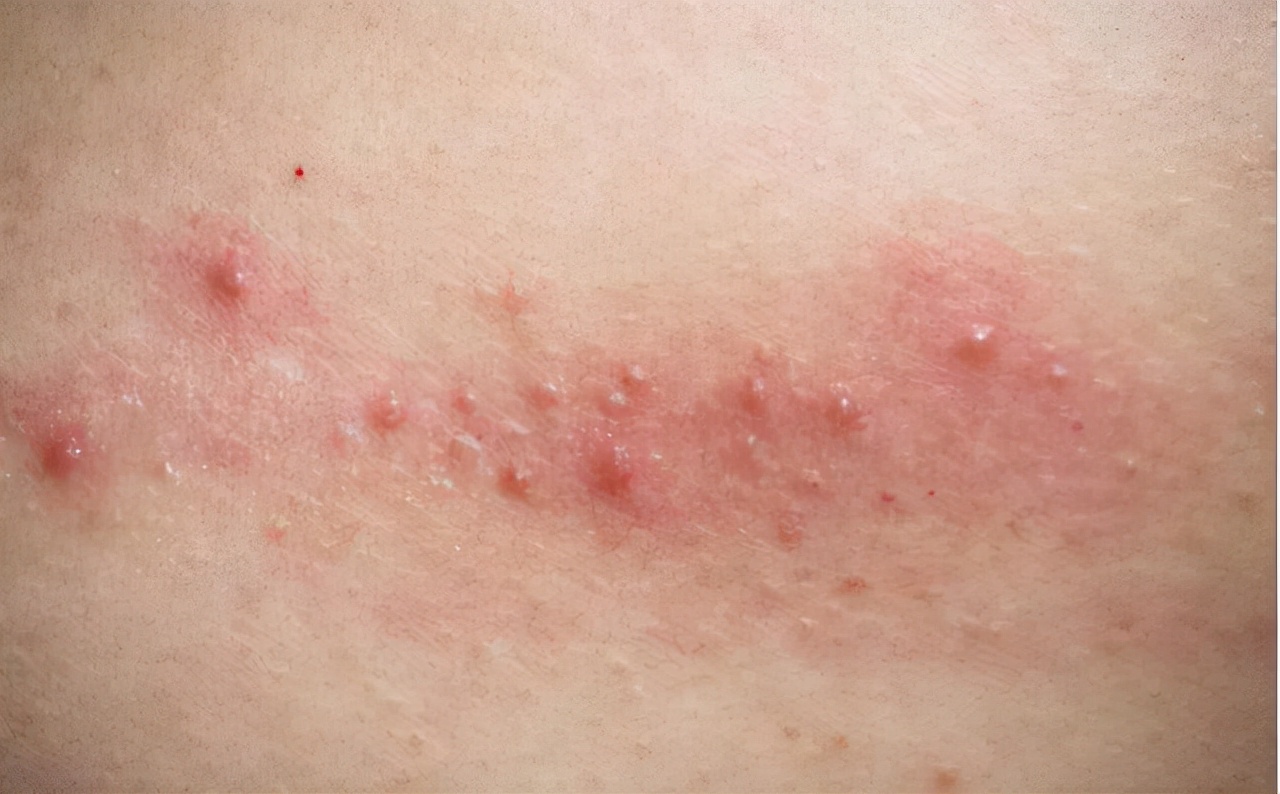 艾滋病在皮肤上会出现什么症状,皮肤灼热疼痛是艾滋病症状吗