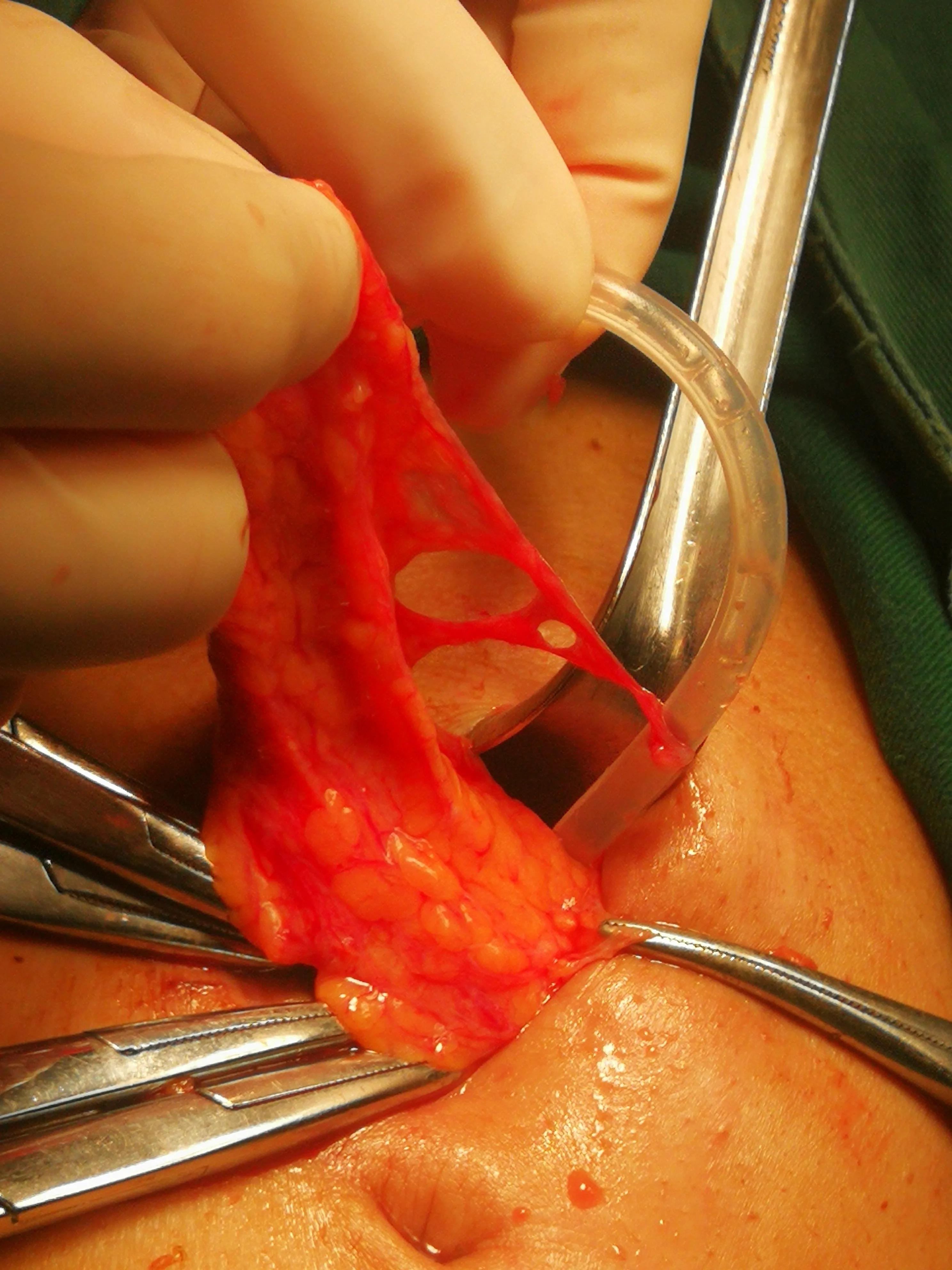 腹膜透析出现腹膜炎的护理措施,腹膜透析居家注意事项