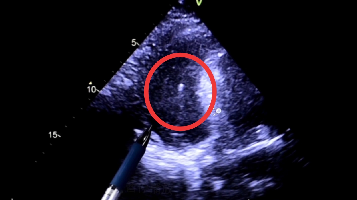 心脏旁边一抽一抽的发紧,心脏扎进一根针能恢复吗