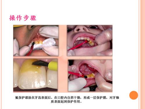 有牙洞用含氟牙膏,牙齿涂氟小知识