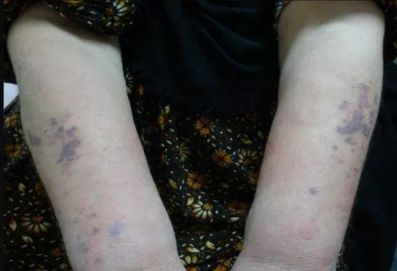 AD可能影响孩子的睡眠、教育、发展和自尊心,但激素药膏要慎用