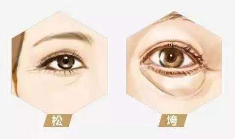 30岁眼部皱纹消除小妙招,40岁女性眼部去皱纹最好的方法