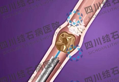 做完体外碎石为什么总大便,体外碎石后出现结石的原因