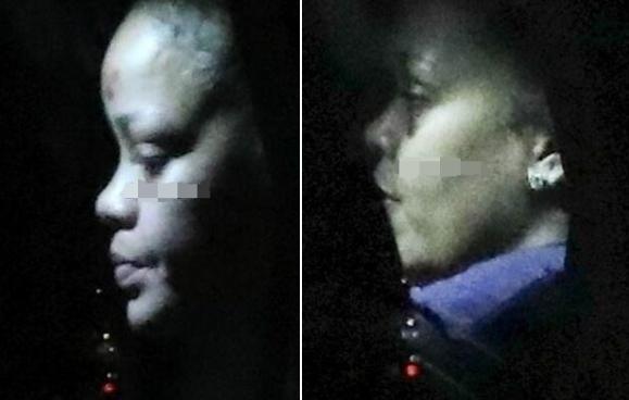 哈娜眼睛受伤,蕾娜受伤视频