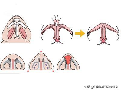 鼻翼缩小术后可以打哈欠吗,鼻翼缩小术三种常见方法