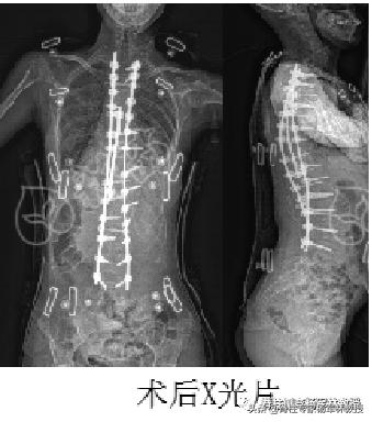 广东脊柱侧弯女孩，一夜挺直腰杆，长高9厘米