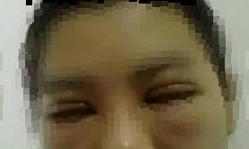 对割双眼皮的看法,你对近视的误解