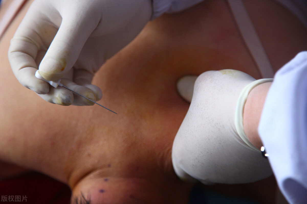 针刀治疗颈椎病效果好吗,针刀可以治颈椎病吗