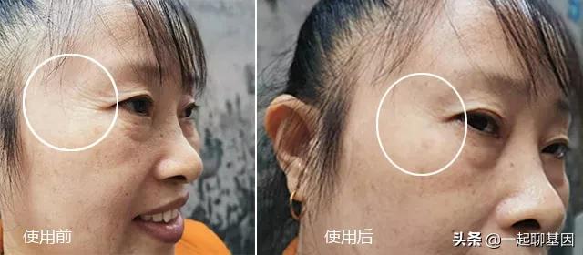 大眼袋眼纹抹平了,眼纹医美怎么去除