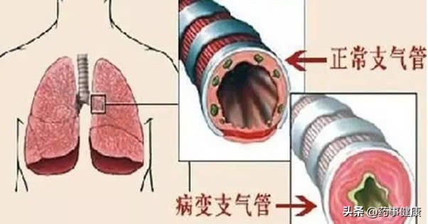 如何分辨支气管炎是慢性还是急性,慢性支气管炎急性发作的健康宣教