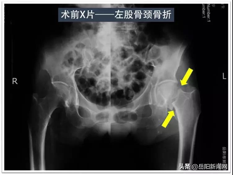 换头手术18小时成功,术后三天直接换头