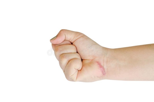 双眼皮疤痕增生凸起小包能自愈吗,伤口疤痕增生凸起的小包能自愈吗