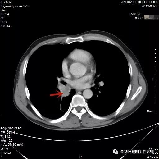 省级医院也漏诊?还好没耽误病情!我们予以行右中下叶袖式切除术