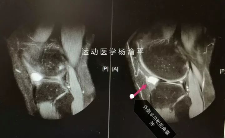 半月板缝合有必要切除滑膜吗,半月板缝合和半月板切除哪个严重