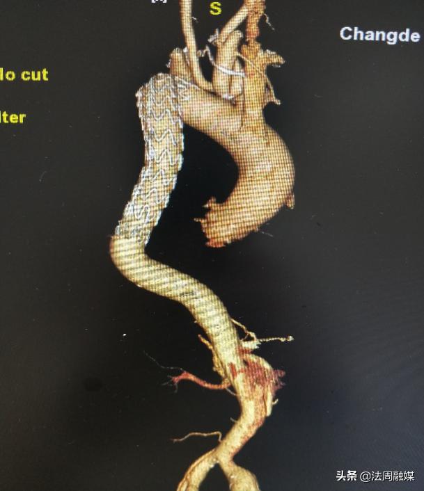 岳阳市一医院主动脉夹层手术,介入微创治疗a型主动脉夹层