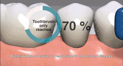 5岁小孩打全麻治蛀牙有影响吗,3岁孩子全麻风险大吗