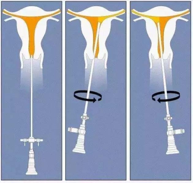 宫腔镜下正常的宫腔是什么样子,宫腔镜人流手术到底做啥