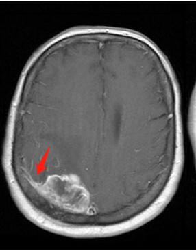 张医生大白话：一文读懂脑膜瘤