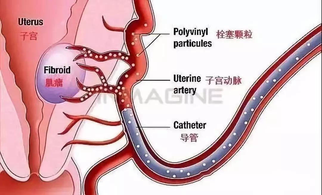 专家讲治疗子宫肌瘤的方法,微创介入子宫肌瘤栓塞术